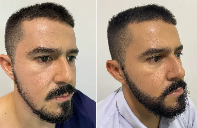 Trasplante de Barba