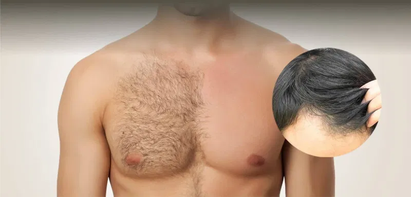 Trasplante de Pelo Corporal (BHT)