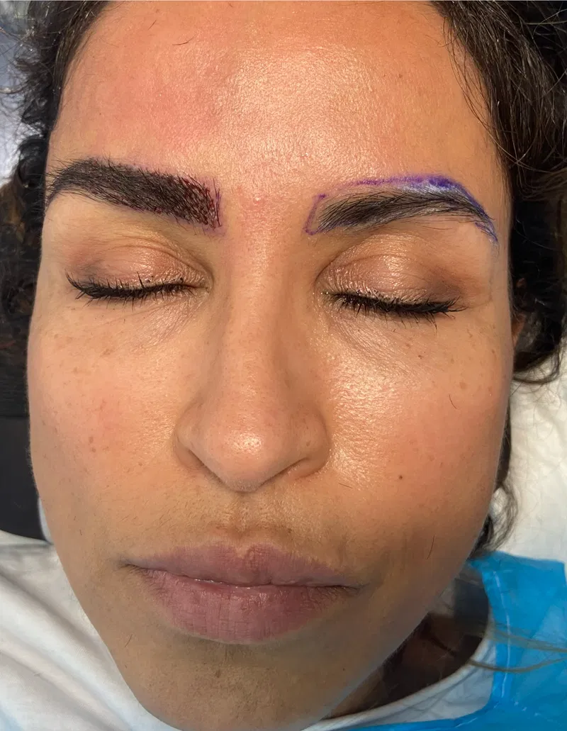 Trasplante de Cejas