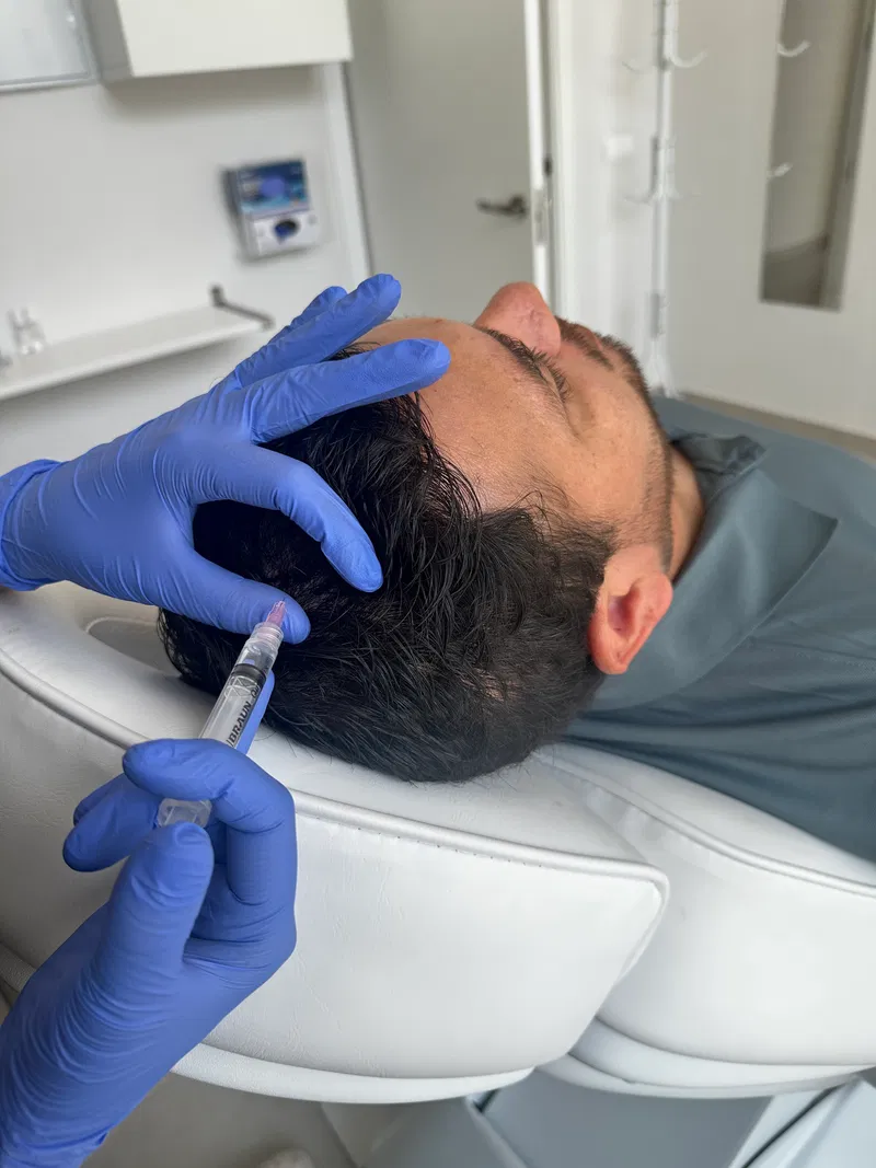 Bioestimulación Capilar (PRP)