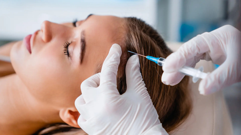 Mesoterapia Capilar