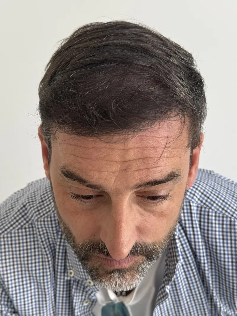 Después: Calvicie Masculina, grado 4, después de 12 meses
