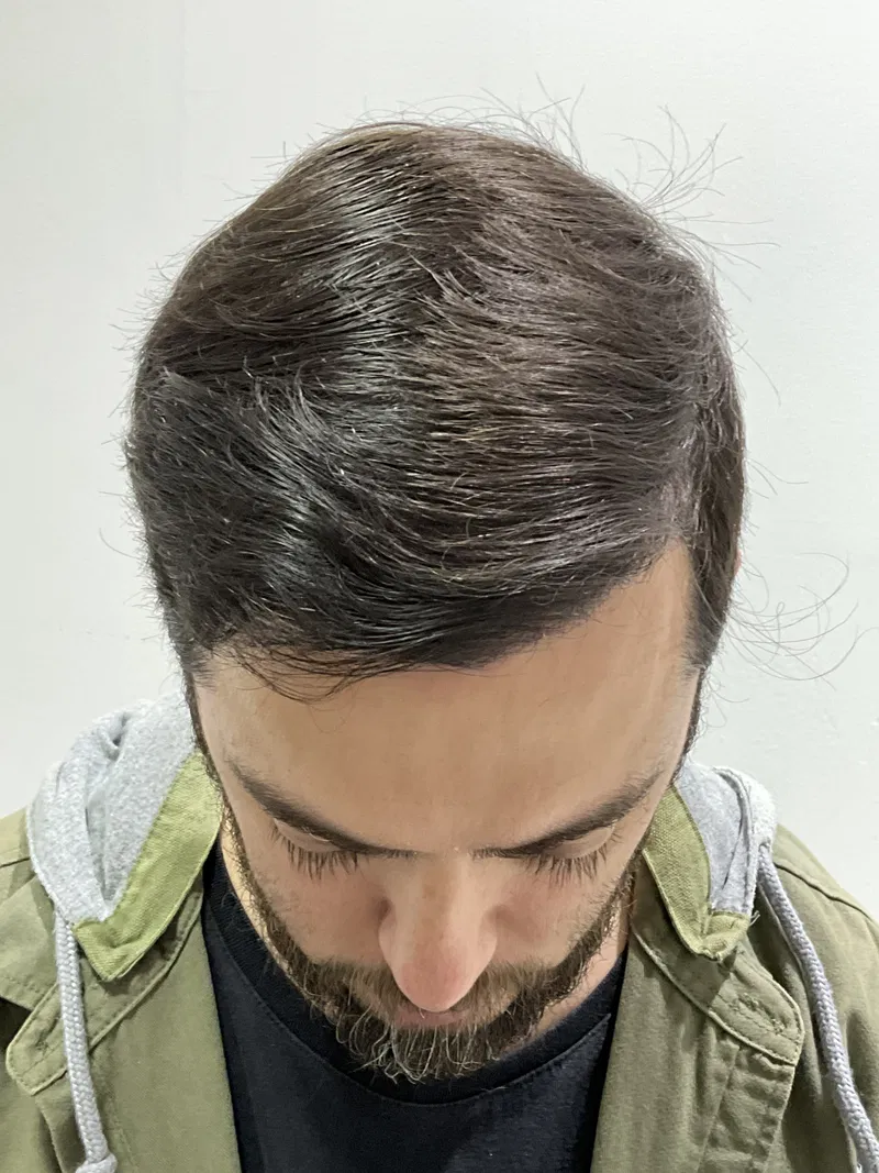 Después: Calvicie Masculina, grado 4, después de 12 meses